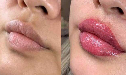 lip color restoration before after oakville mississauga